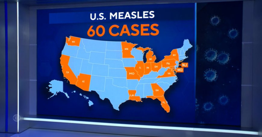 US measles milestone: 60 cases so far in 2024 — more than all of 2023