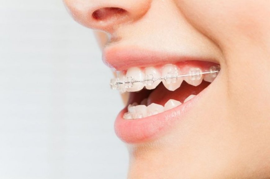 ‘Fashion braces’ rising among young people as hot new accessory